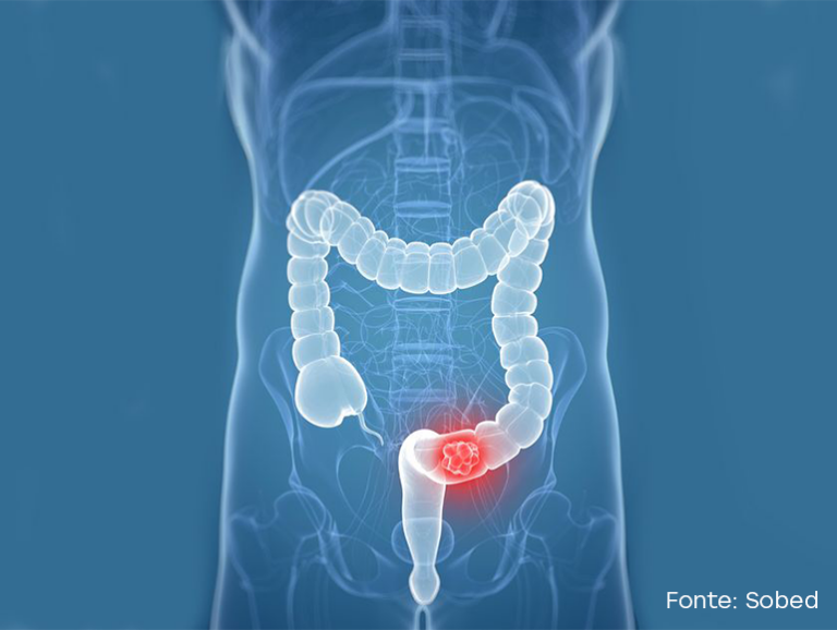 Câncer no Intestino, o tratamento precoce salva vida